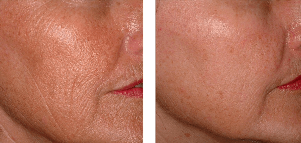 derma