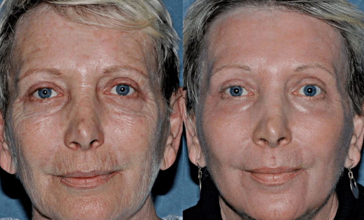 prima e dopo